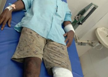 बेदम मारहाण करून आगीत ढकलले